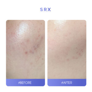 retinol a cream srx hiệu quả không